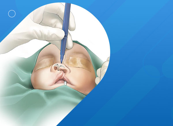 An anatomical composite nasal lining subunit technique in primary cleft nose correction 