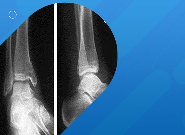 A simultaneous fracture of the tibia and talar body